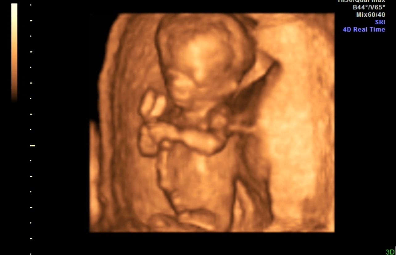 3D ultrasound scan showing a fetus curled up in the womb