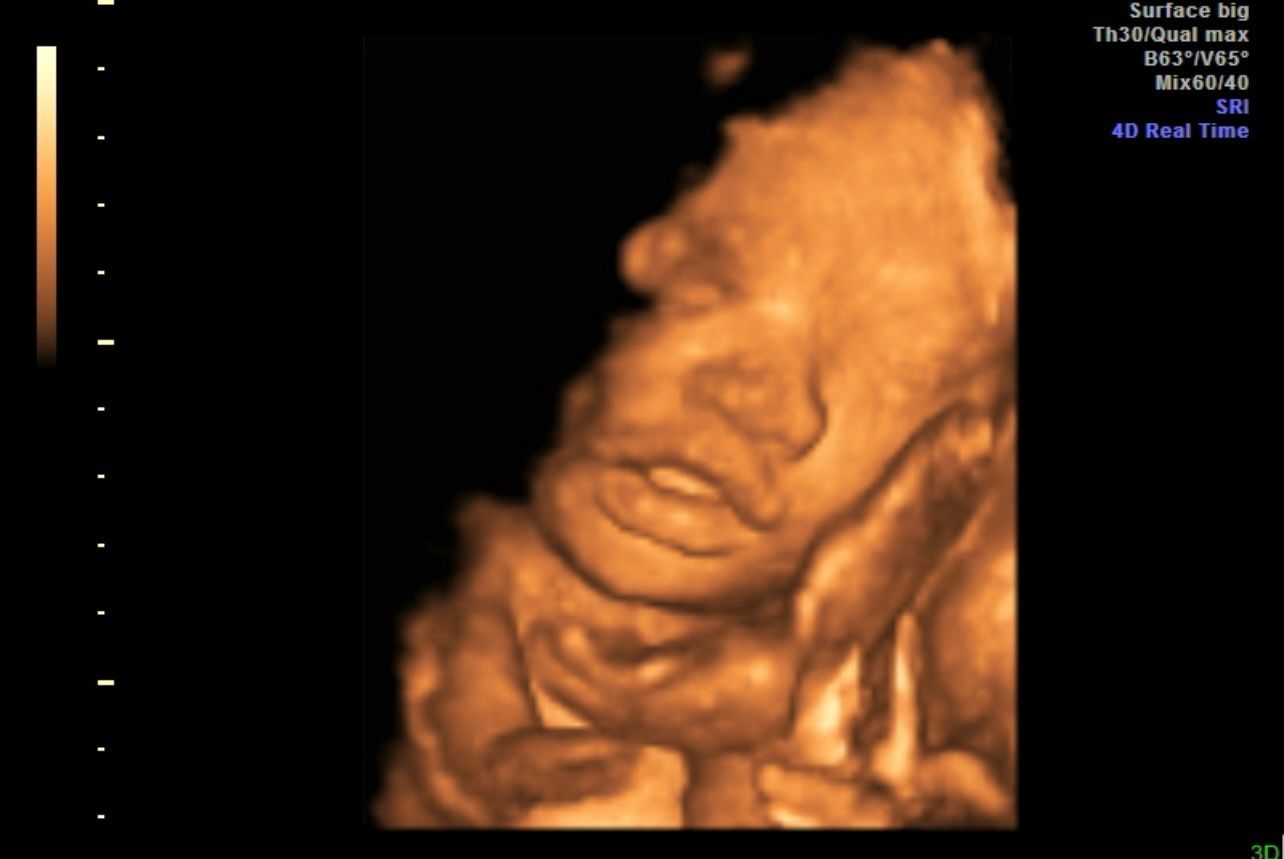 Orange 3D ultrasound of a fetus’s face, eyes closed, on a black background