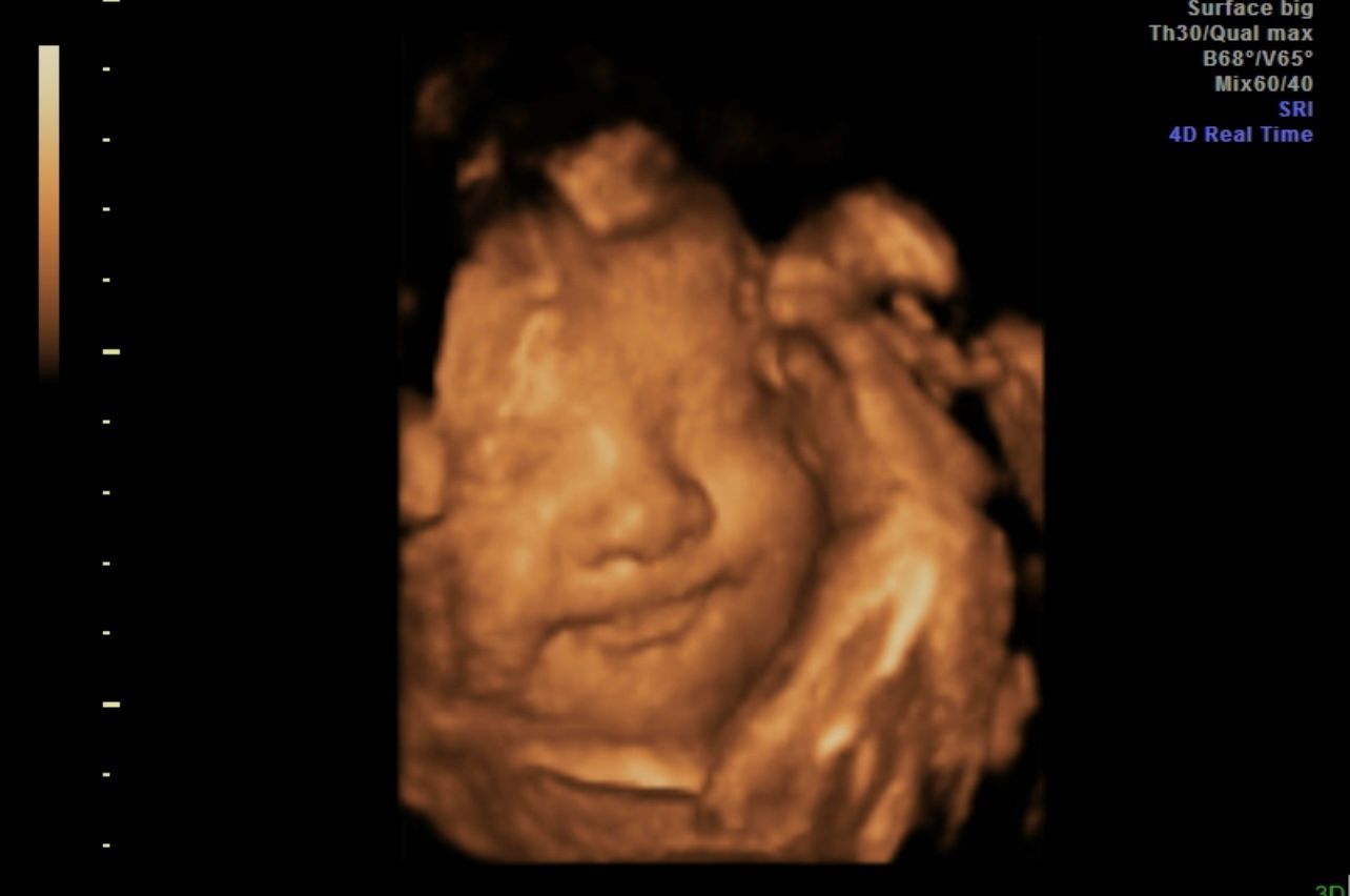 3D ultrasound of a fetus's face in warm brown tones