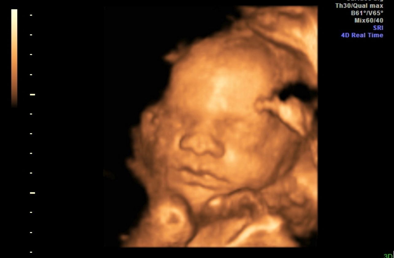 3D ultrasound image of a fetus with a visible face, rendered in warm orange tones on a black background