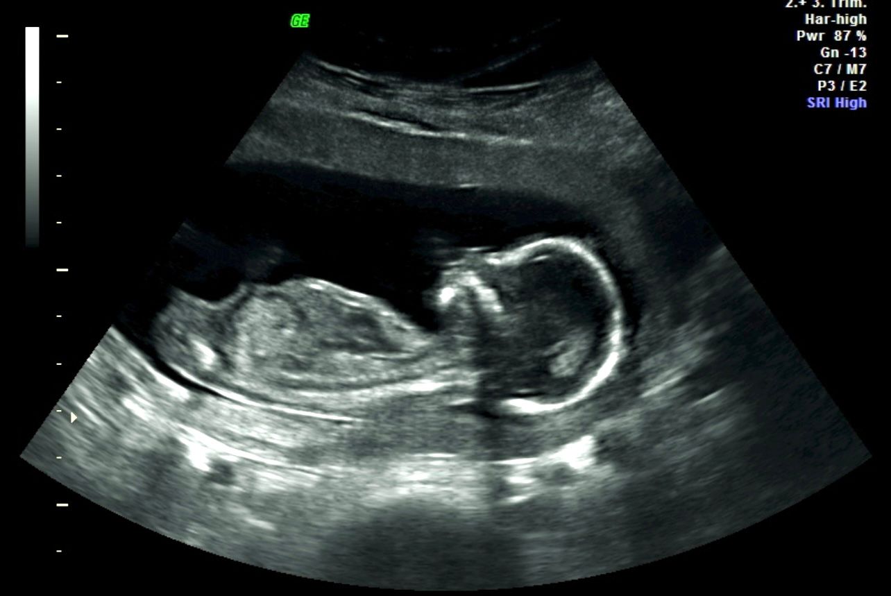 Ultrasound scan showing a fetus in profile inside the womb