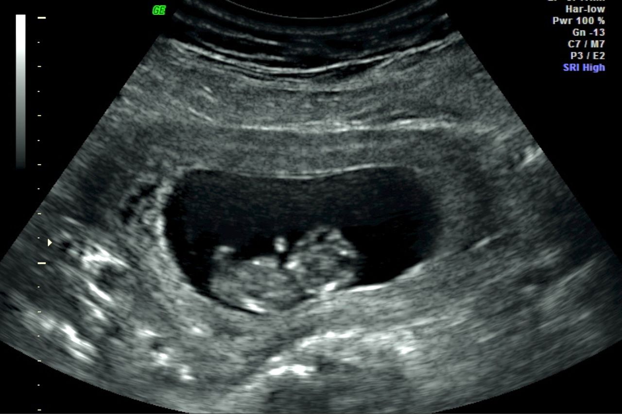 Ultrasound scan showing a fetus in the womb
