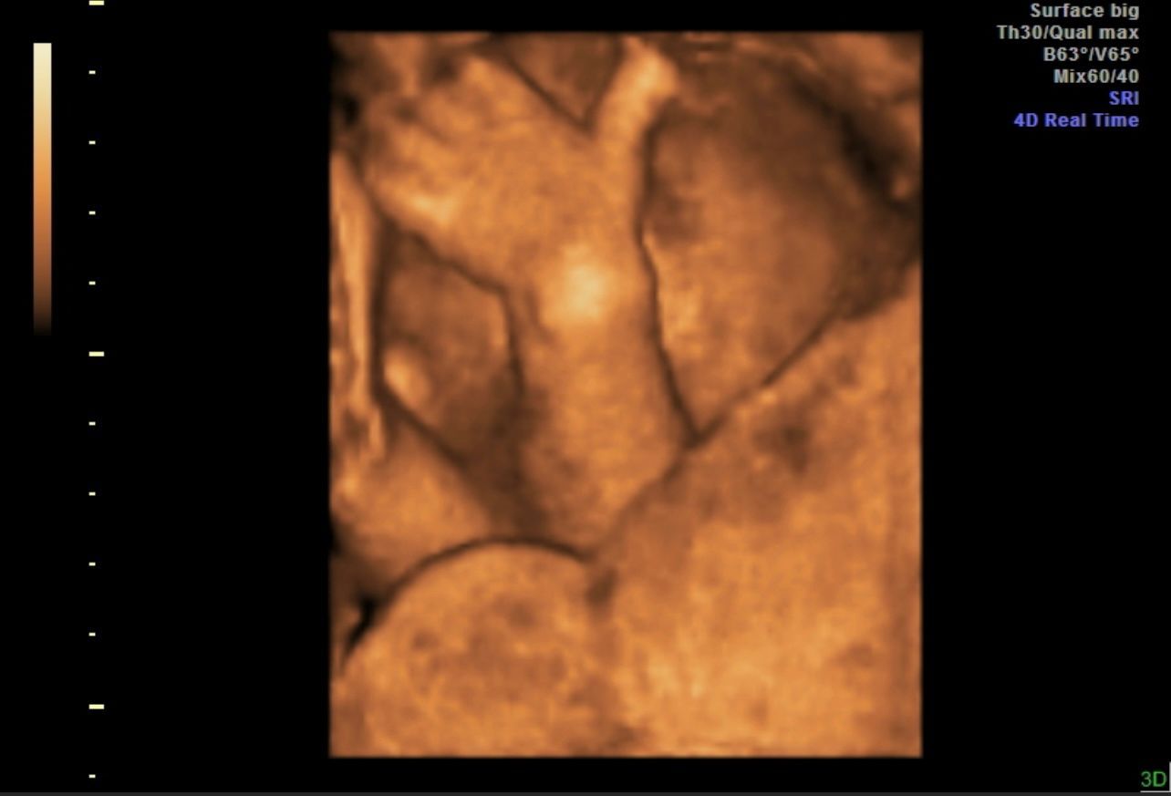 Sepia ultrasound scan showing a fetal face in profile, with on-screen medical text.