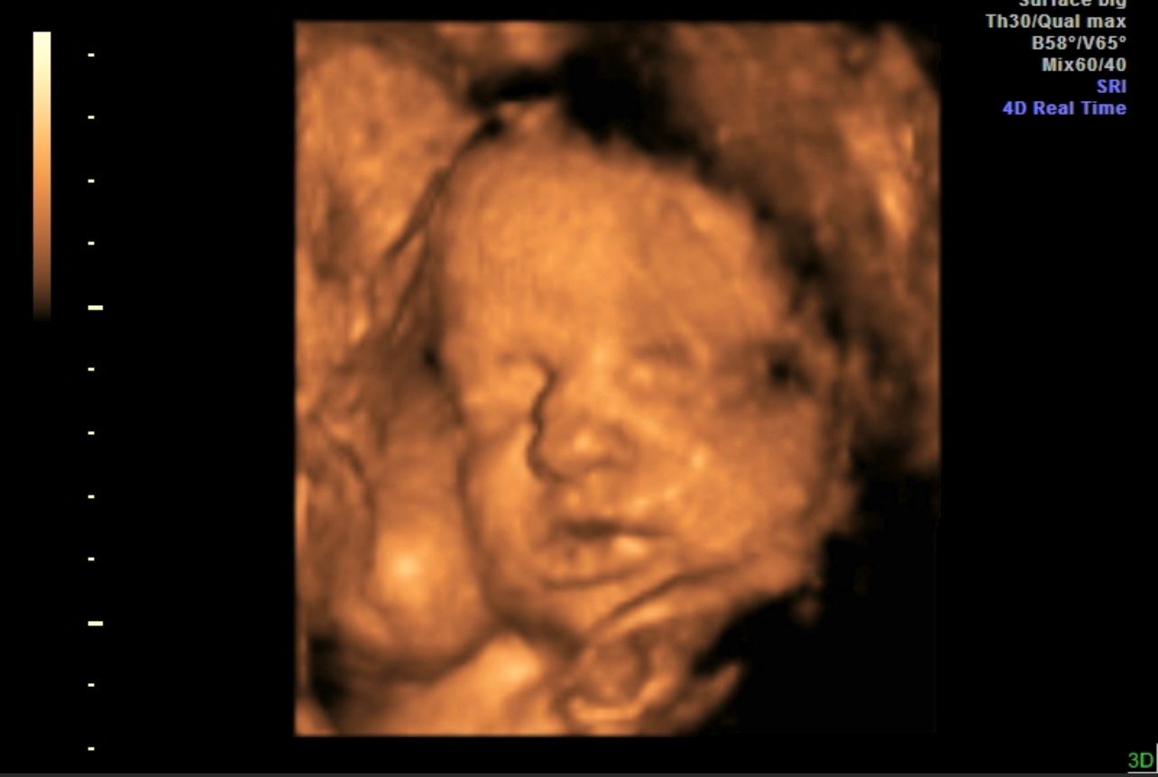 3D ultrasound image of a fetus’s face in warm sepia tones