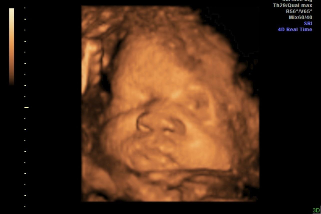 3D ultrasound scan of a fetus showing a close-up face in warm sepia tones