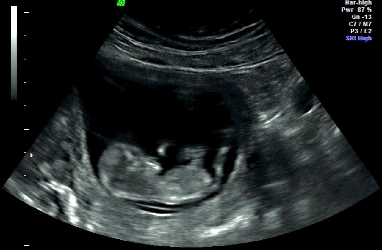 Fetal ultrasound showing a baby in profile inside the womb