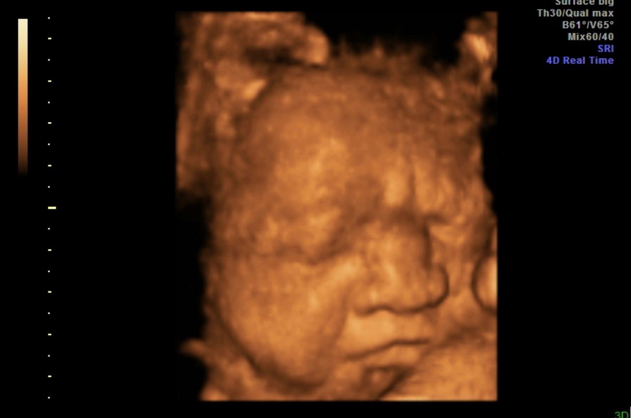 3D ultrasound scan showing a fetal face in warm brown tones