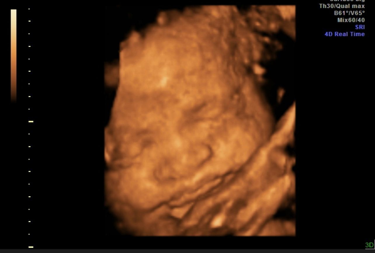 3D ultrasound image of a fetus, shown in amber tones against a black background