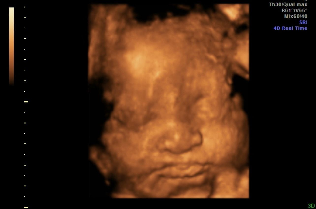Sepia-toned ultrasound scan showing a fetus’s face in close-up