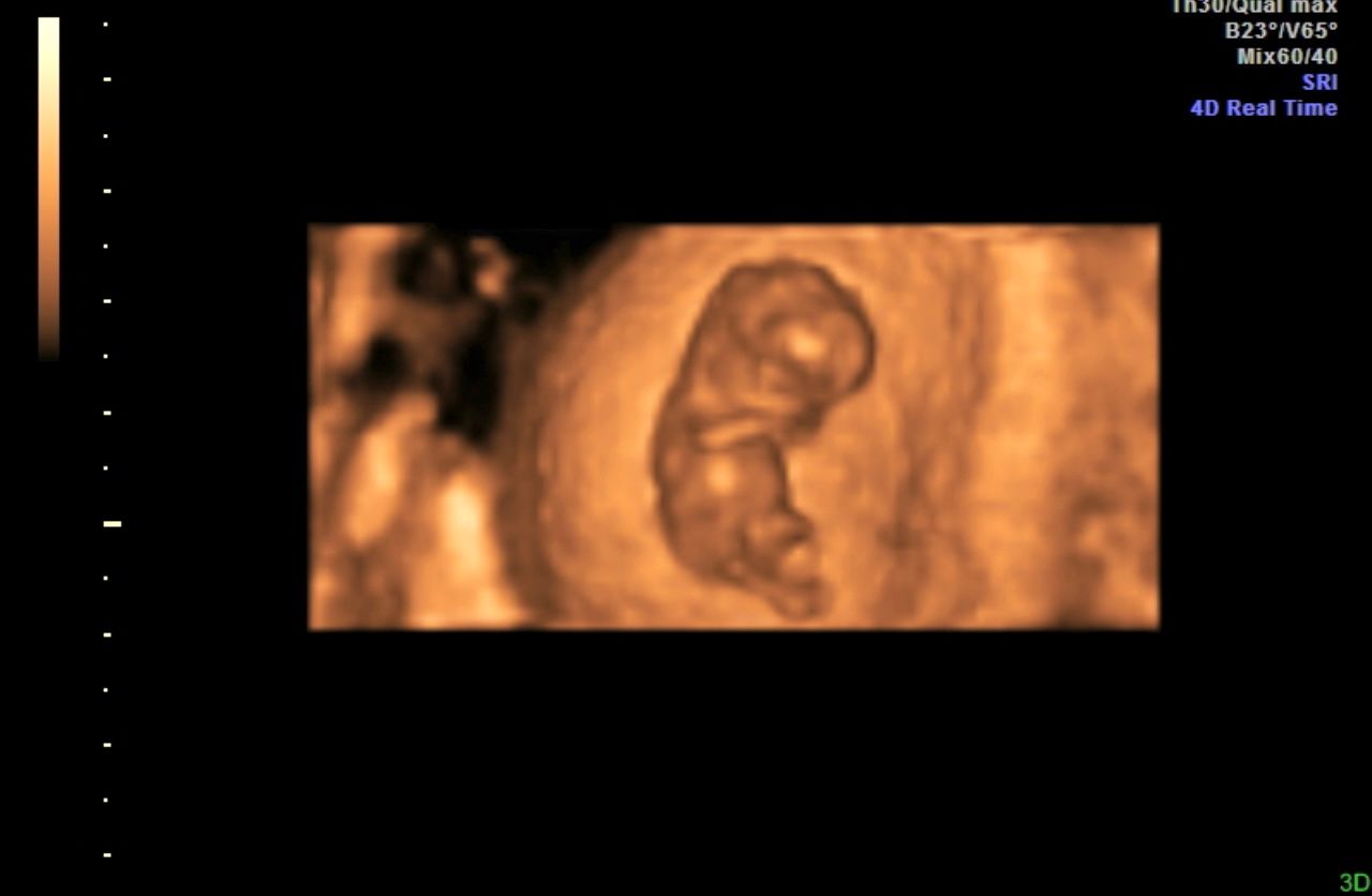 3D ultrasound showing a curled fetus in a womb