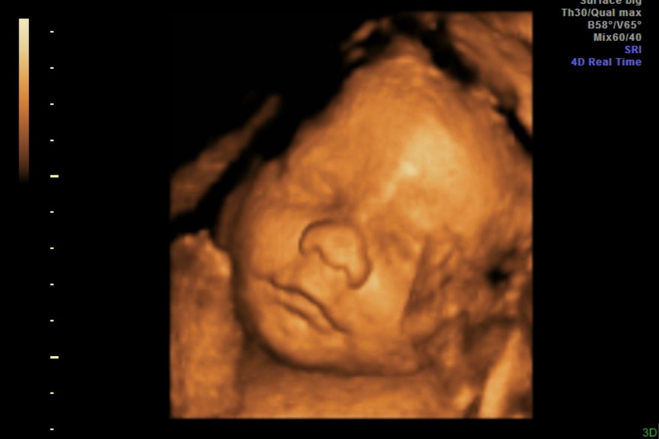 3D ultrasound image of a fetus’s face, eyes closed, in warm sepia tones