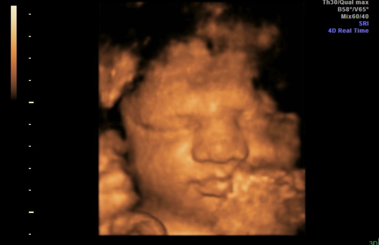 3D ultrasound of a baby's face, with closed eyes and soft orange tones on a black background