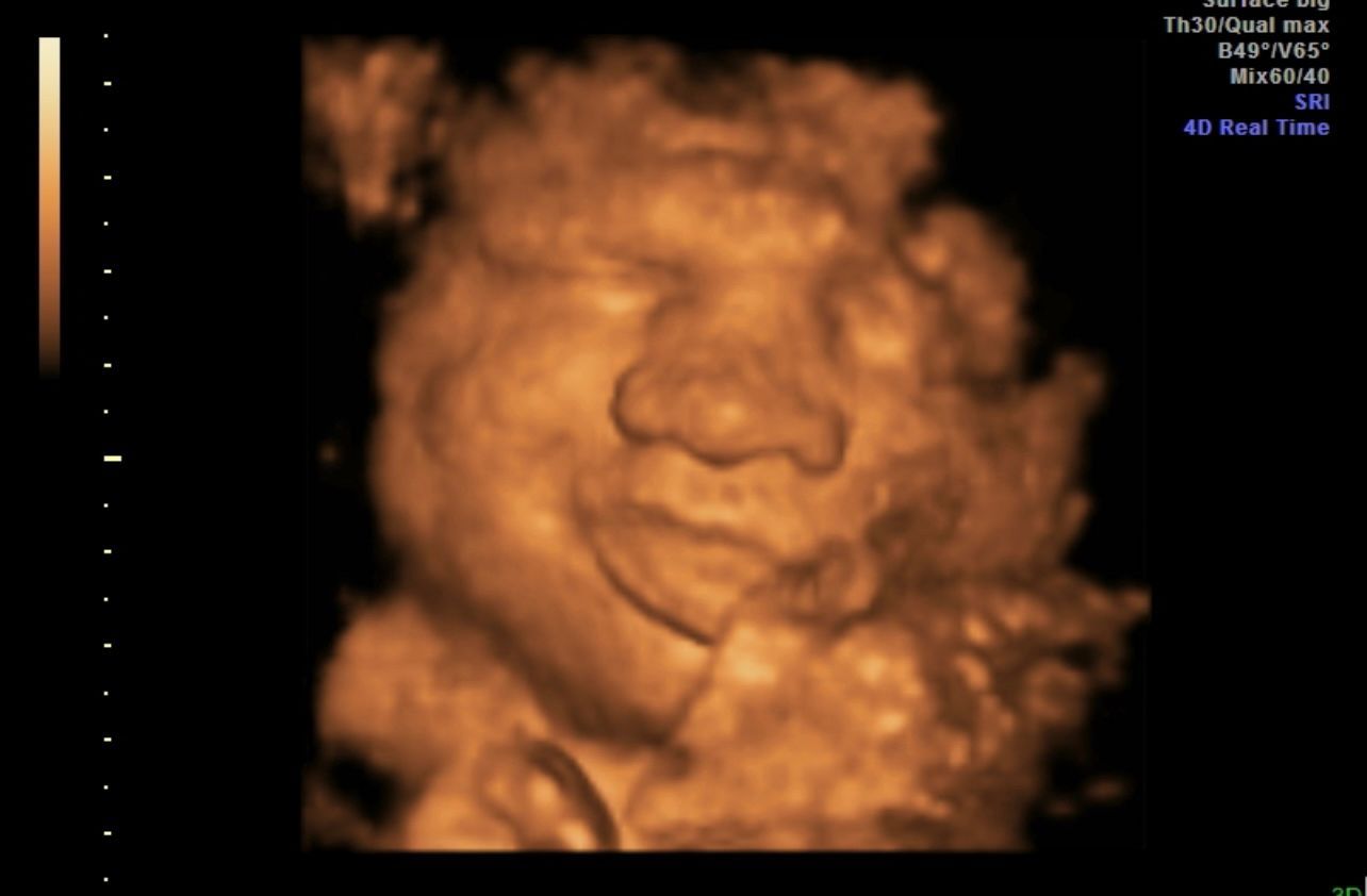 3D ultrasound image of a fetus’s face in warm orange tones on a black background