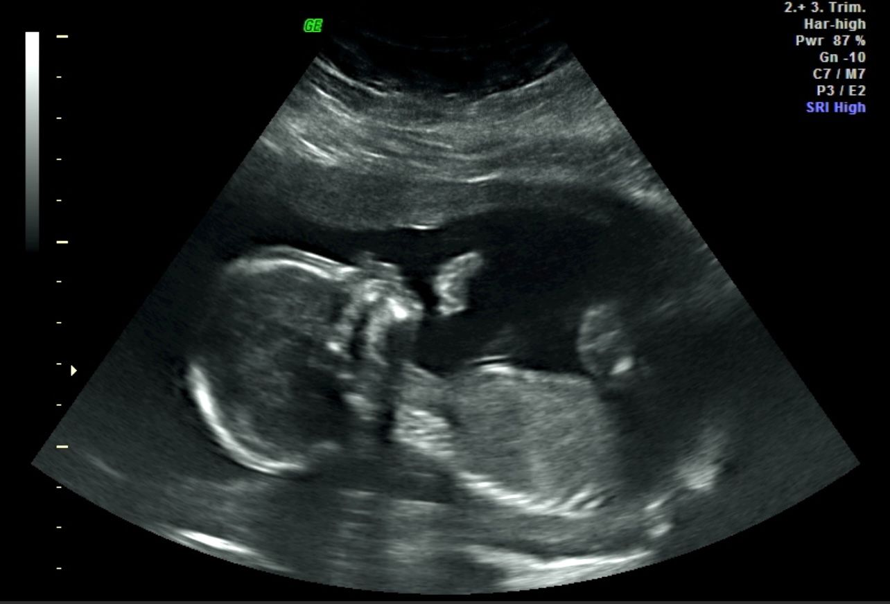 Ultrasound scan showing a fetus in profile inside the womb