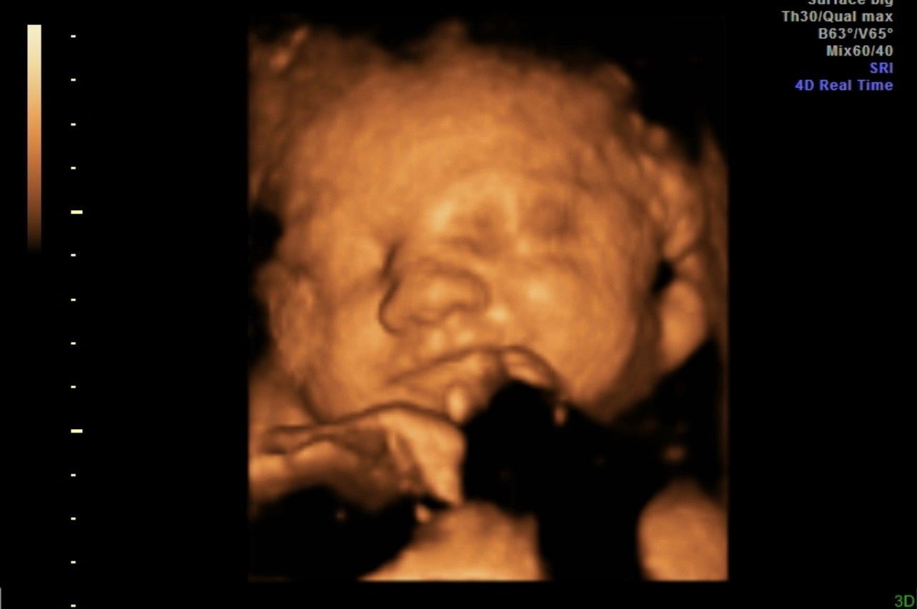 Ultrasound image of a sleeping baby in warm orange tones, with a hand near the face