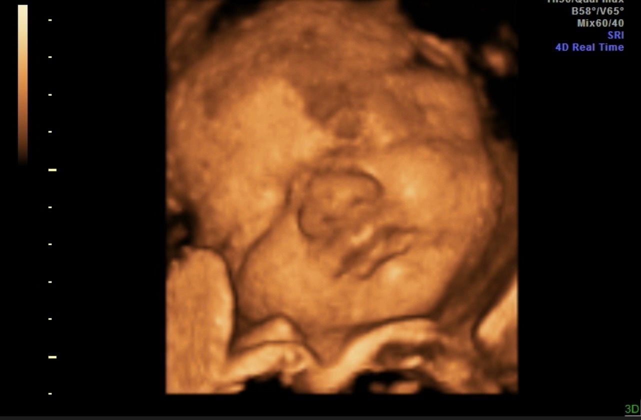 3D ultrasound of a fetus, with the face visible against a dark background