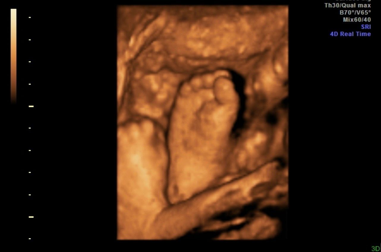 3D ultrasound showing a baby’s foot and hand in the womb, with a brown-orange sonogram background