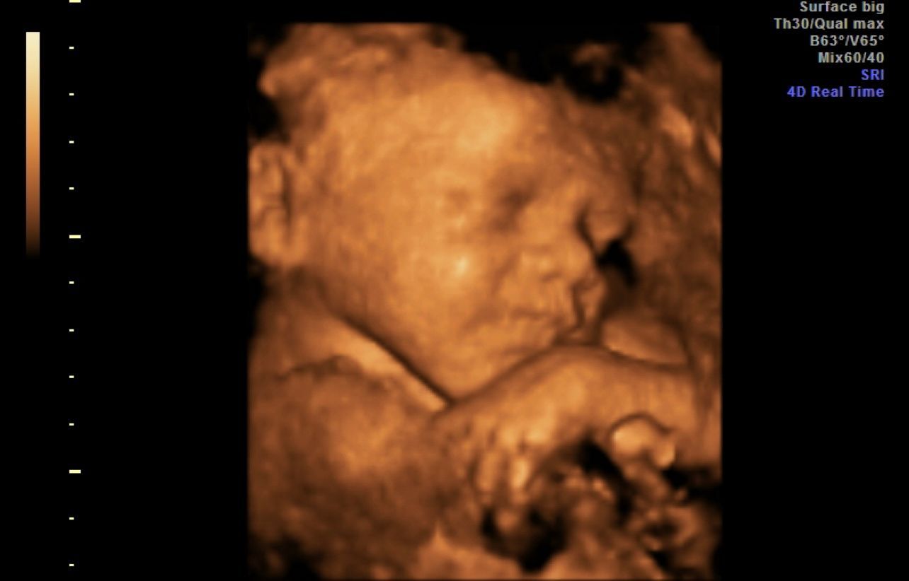 Sepia 3D ultrasound showing a fetus curled up with face and hand visible