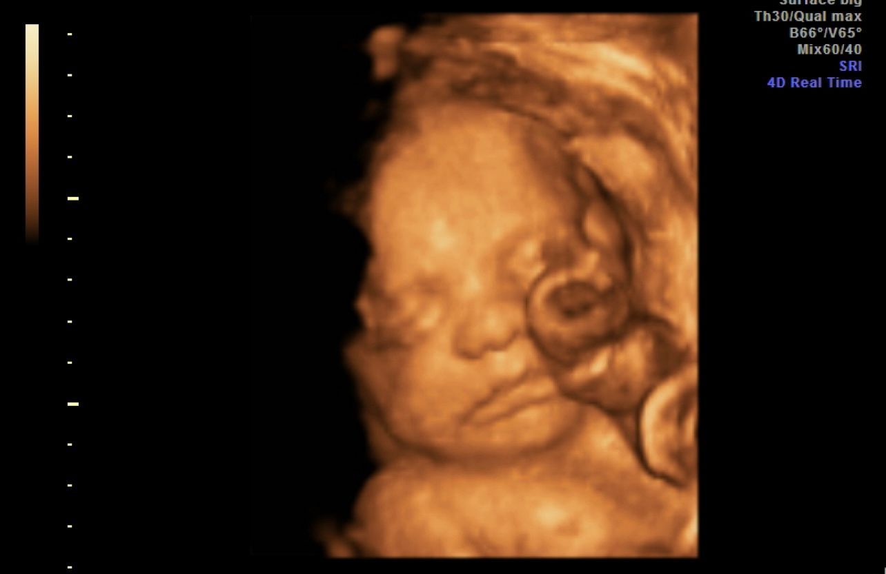 3D ultrasound of a fetus sleeping, with face visible in warm orange tones