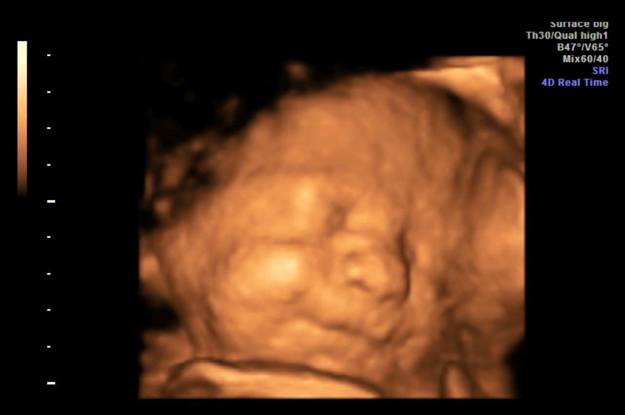 3D ultrasound of a fetus curled in the womb, shown in warm orange tones