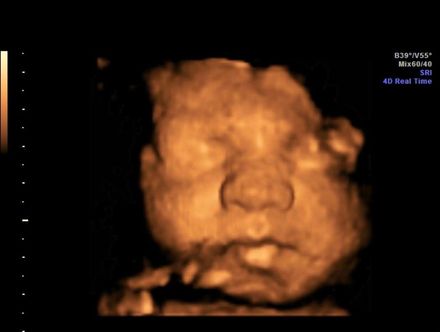 Sepia 3D ultrasound of a fetus’s face, with closed eyes and lips visible on a black background