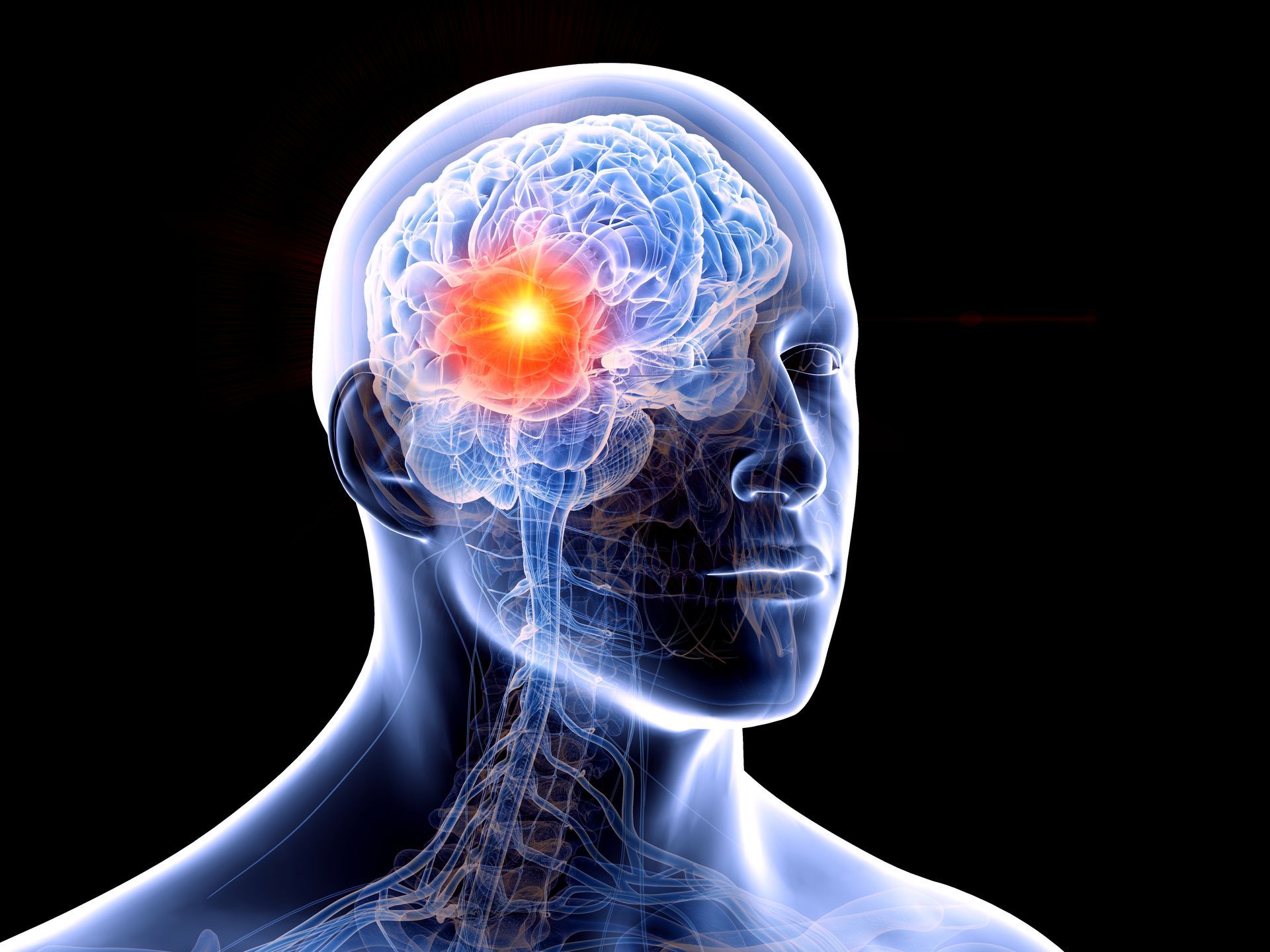 Metastase no cerebro tem cura Metastase no cerebro tem cura