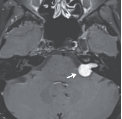 schwannoma vestibular ou neurinoma do acústico schwannoma vestibular ou neurinoma do acústico