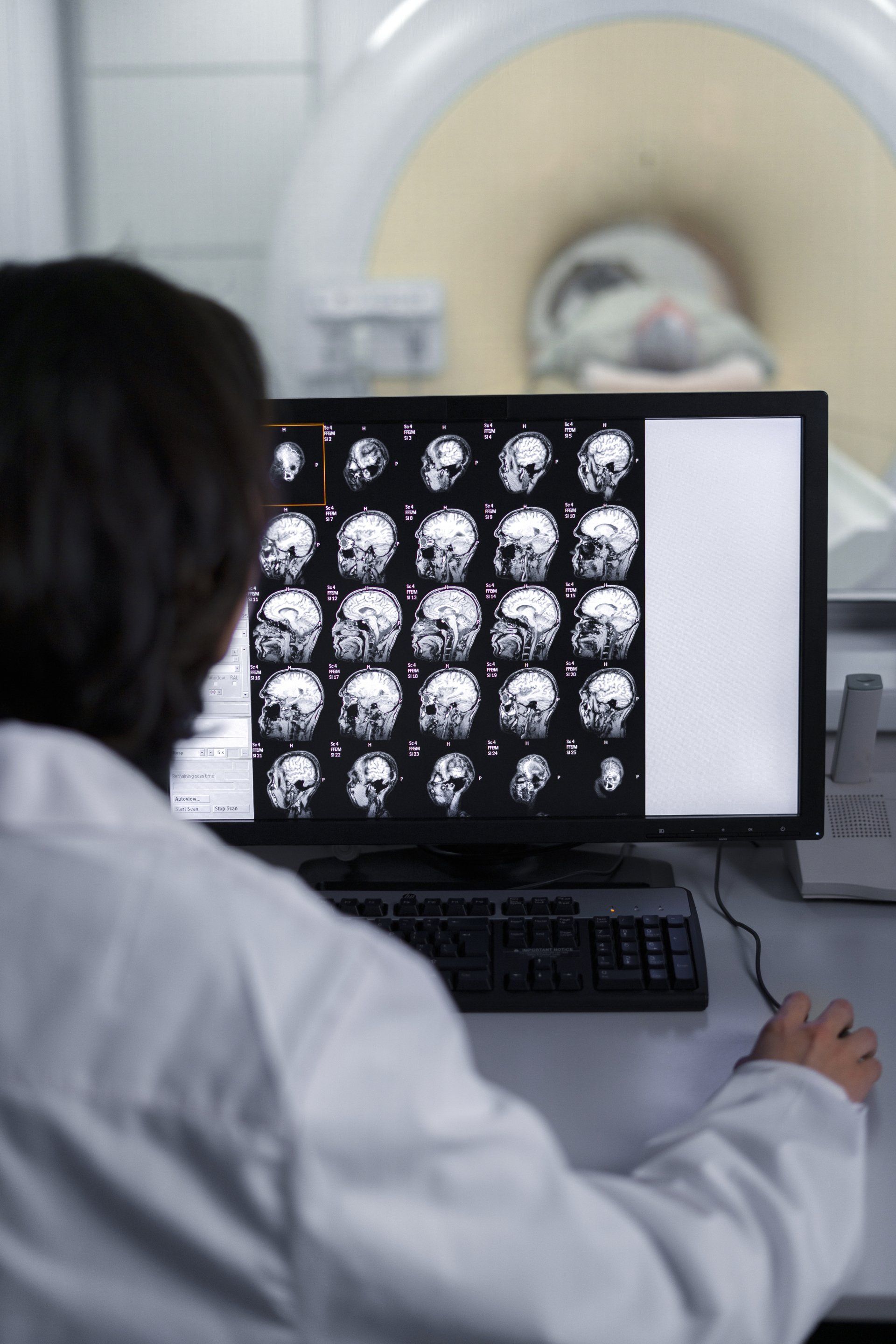 Como é feito o diagnóstico do schwannoma vestibular Como é feito o diagnóstico do schwannoma vestibular