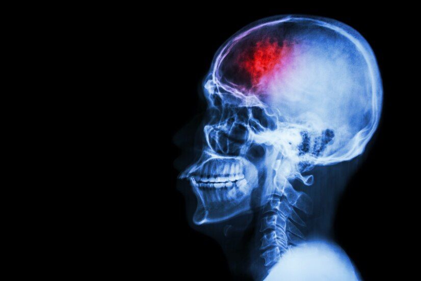 Cirurgia para fraturas cranianas: quando é necessária Cirurgia para fraturas cranianas: quando é necessária