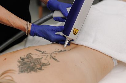 A Woman is Getting a Tattoo Removed From Her Back — Renew Laser Clinic in Taree, NSW