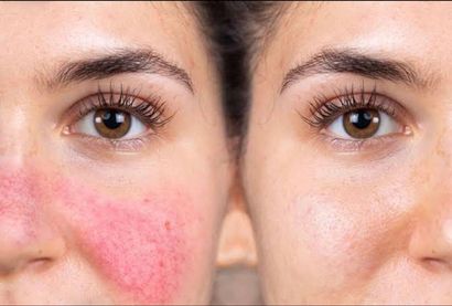 A Before and After Photo of a Woman's Face With Red Spots — Renew Laser Clinic in Taree, NSW