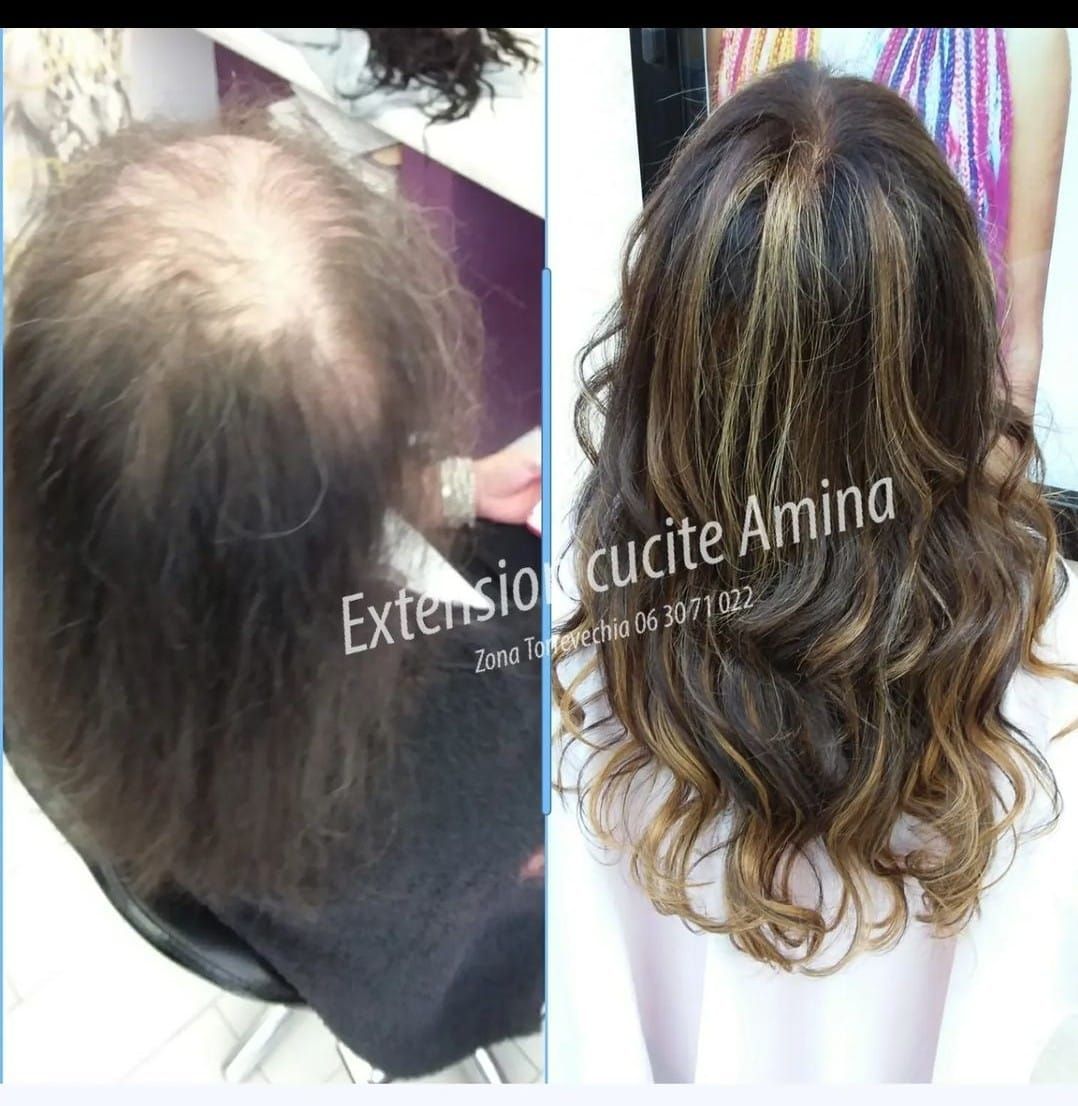 extension su cliente con alopecia