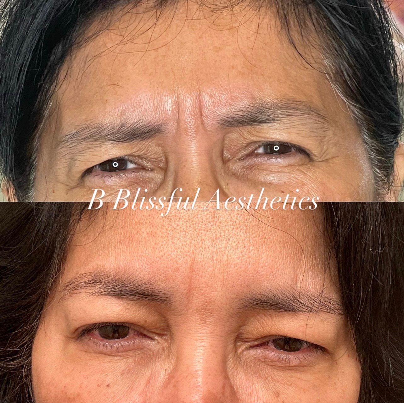 A before and after photo of a woman 's forehead and a man 's forehead.
