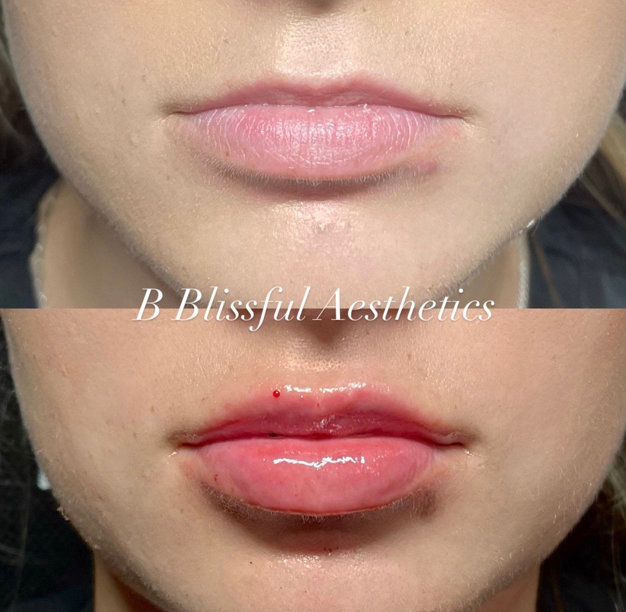 A before and after photo of a woman 's lips.