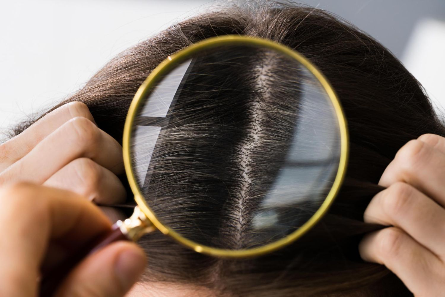 Hands part hair under a magnifying glass, showing thinning scalp and dark hair.