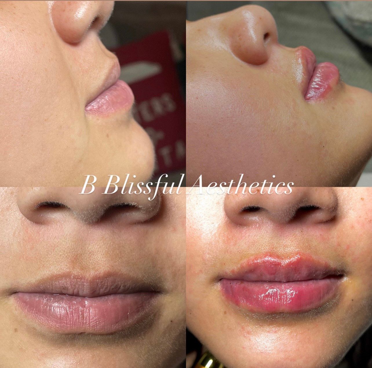 A woman 's face is shown before and after lip injections by blissful aesthetics