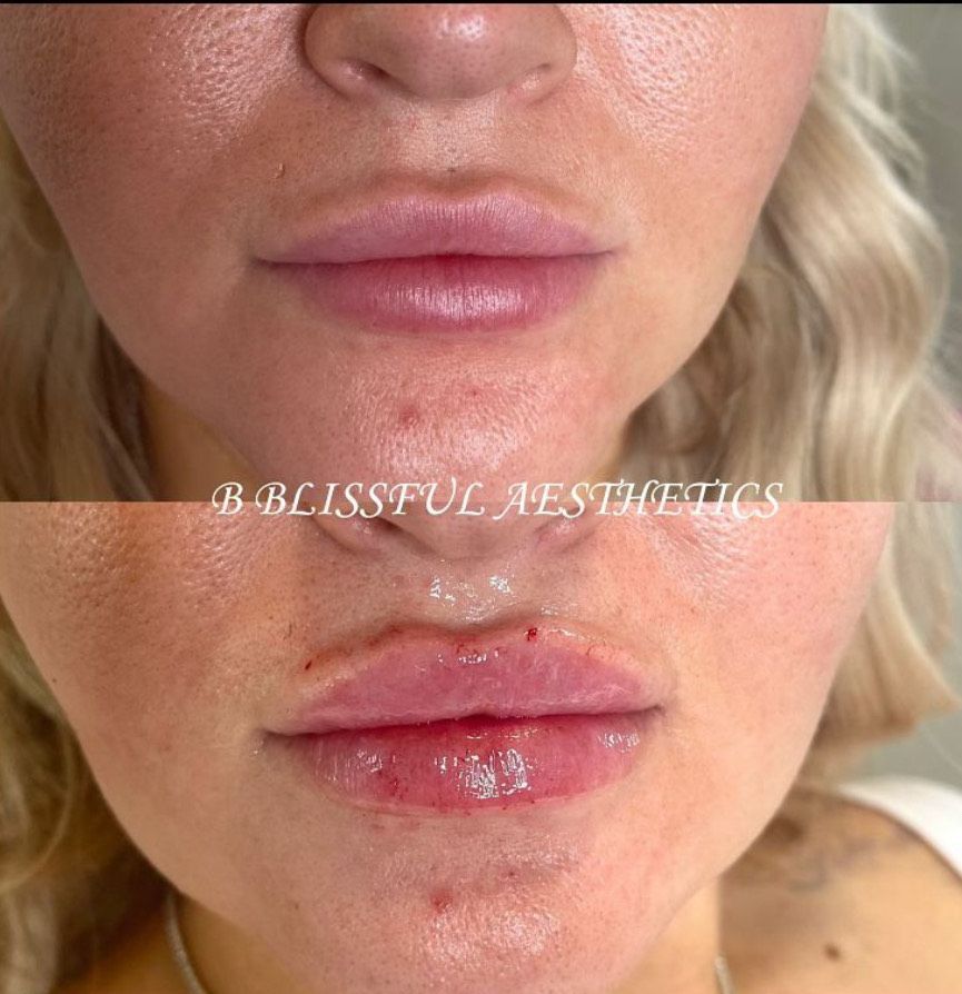 A before and after photo of a woman 's lips taken by blissful aesthetics