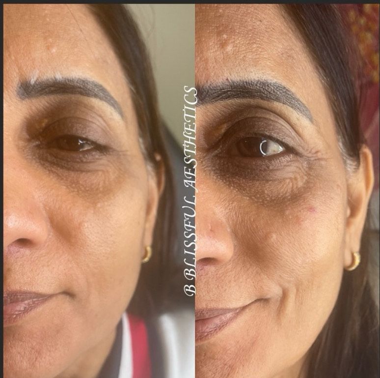 A before and after photo of a woman 's face says blissful aesthetics