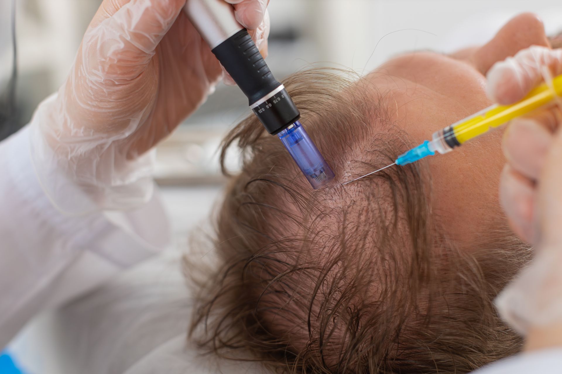 A person is getting a hair treatment with a syringe.