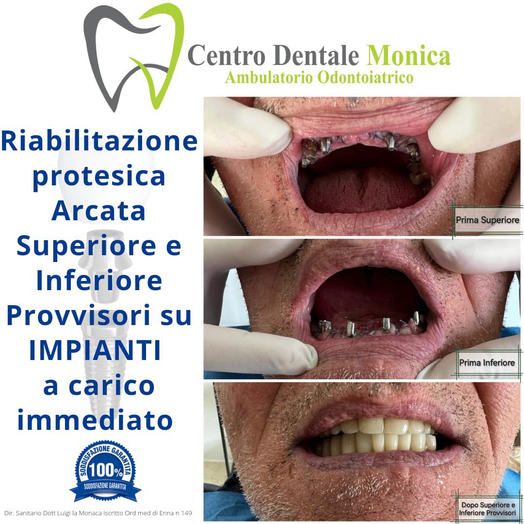 impianti a carico immediato