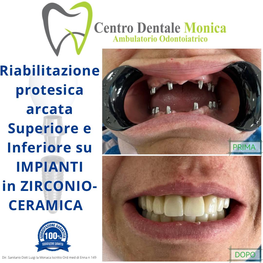 impianti in ceramica