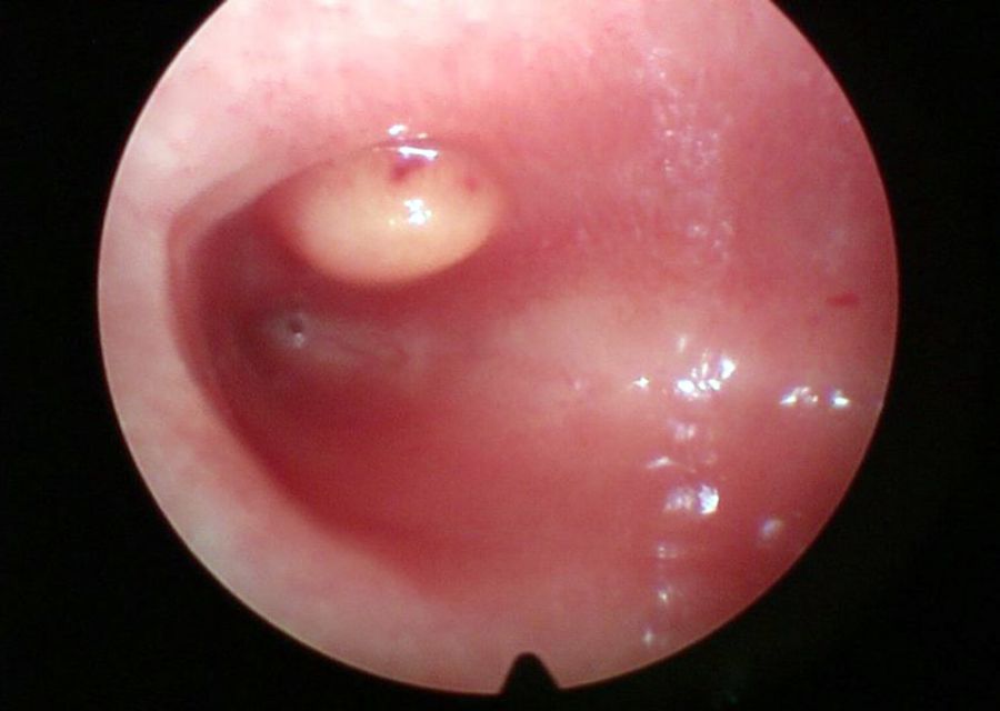 Isteroscopia