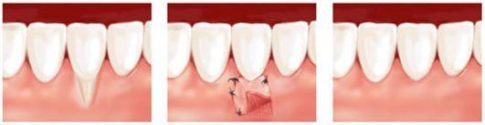 Greffe gingivale