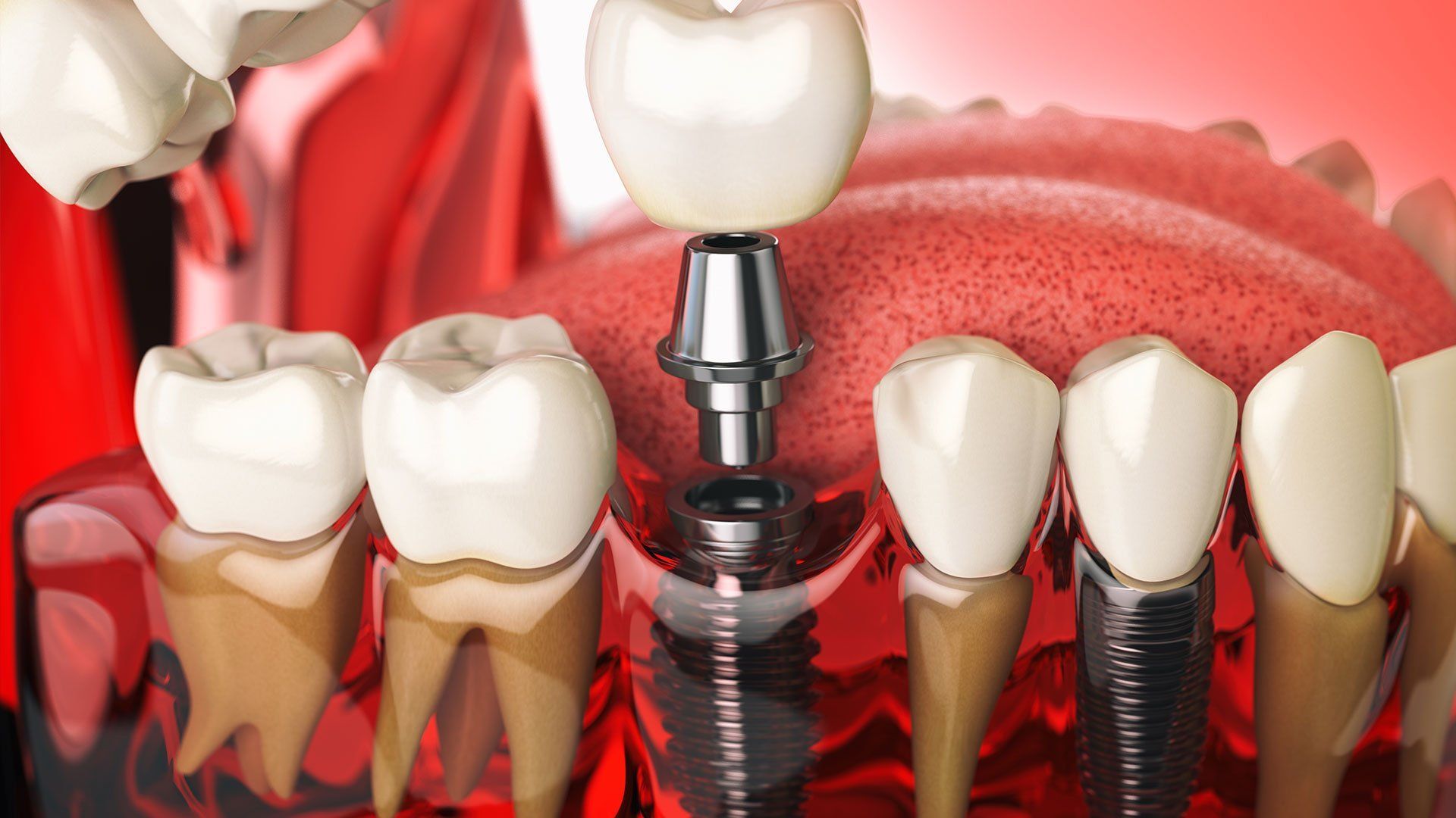 Implants dentaires