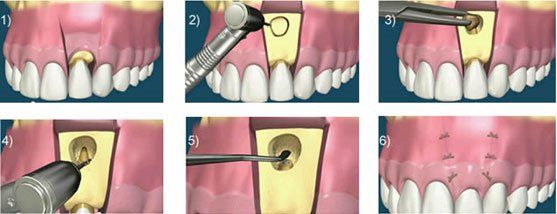 Resection apicale