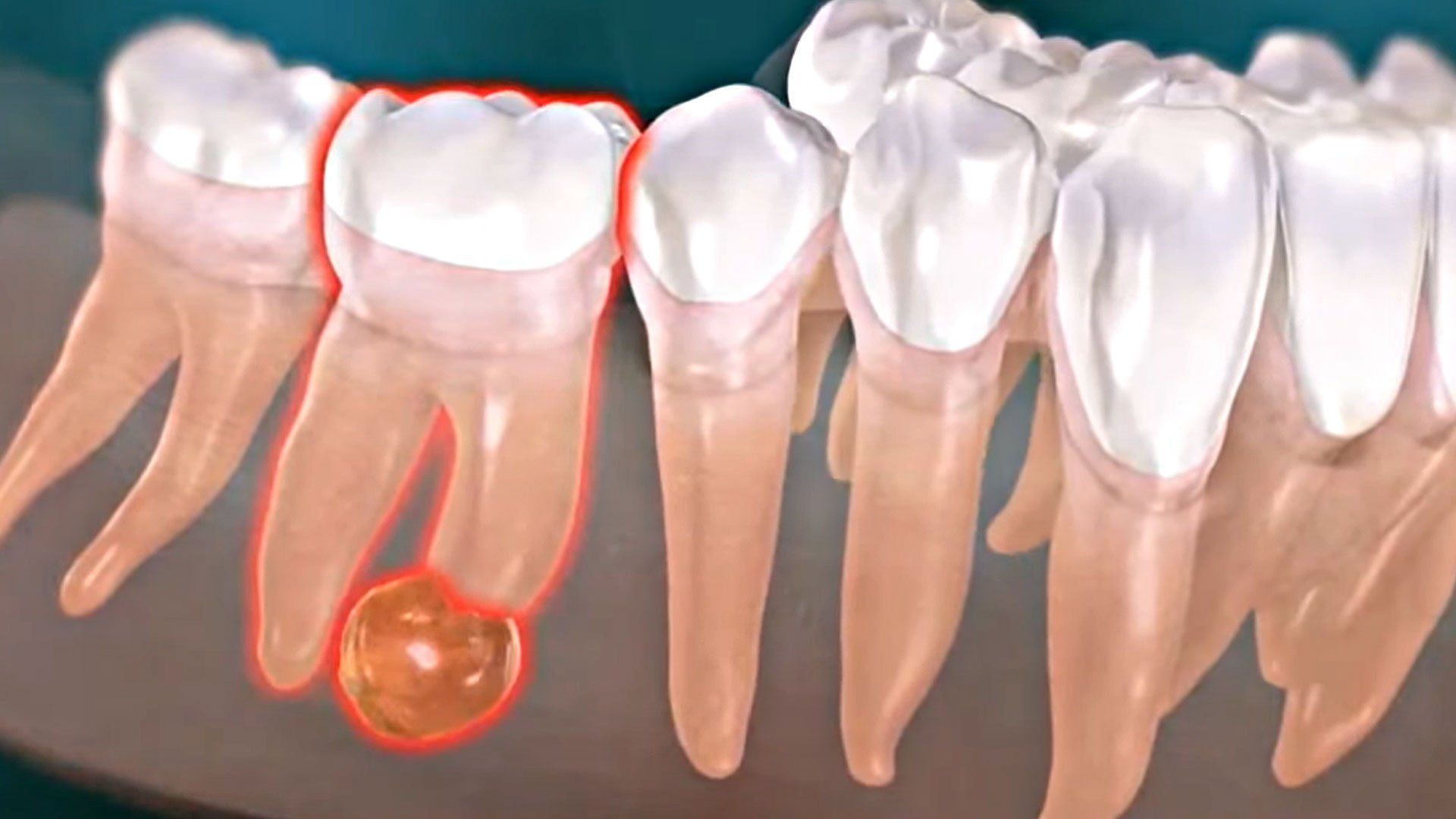 Resection apicale