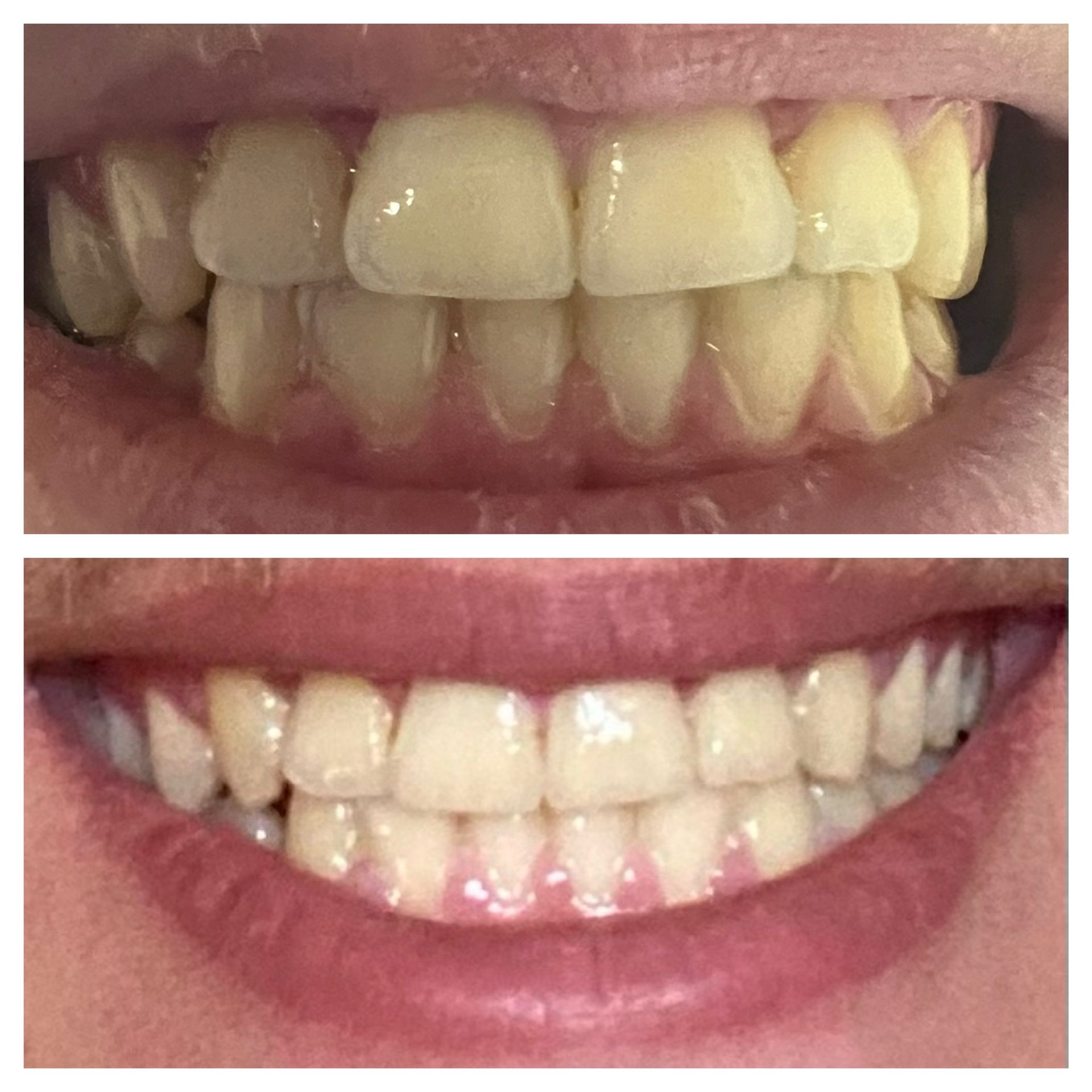 Teeth Whitening Results | Brite Smiles by Heather