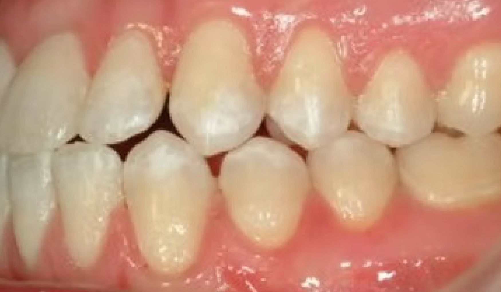 Braces Doc Before and After