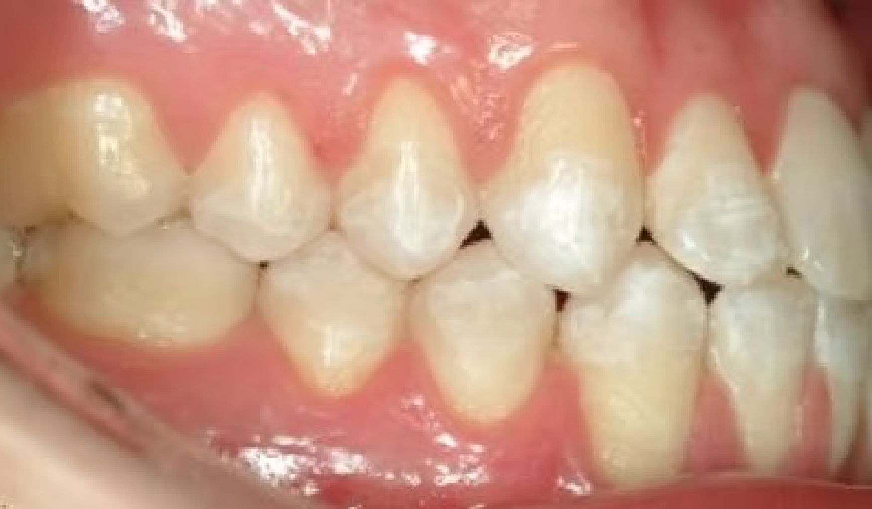 Braces Doc Before and After