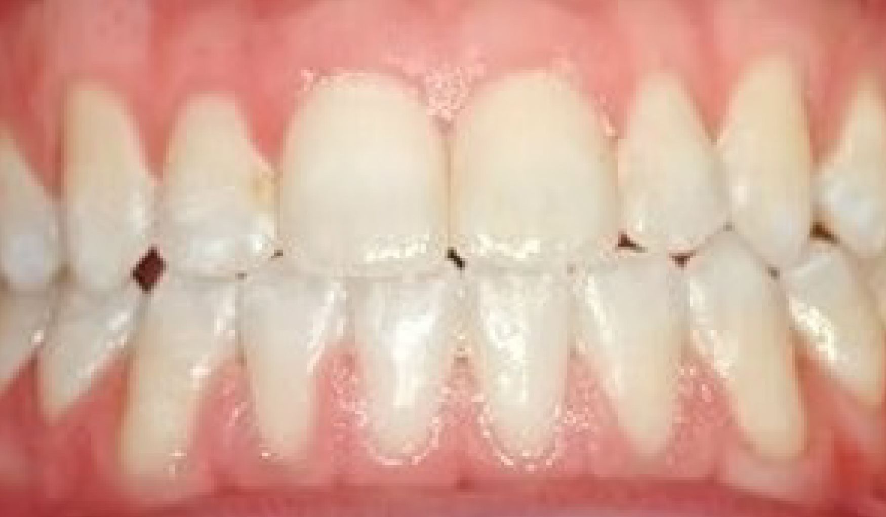 Braces Doc Before and After
